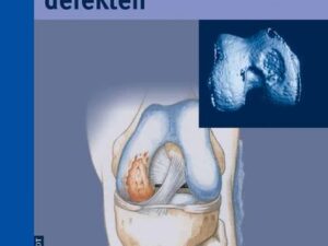 Die Behandlung von Gelenkknorpeldefekten